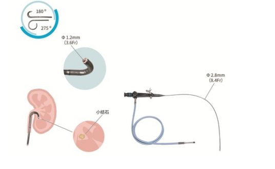 纖維輸尿管腎孟鏡