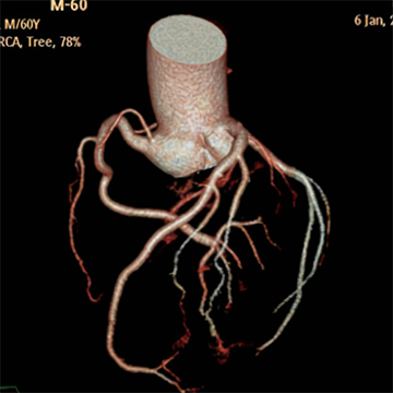 Yizhun CACIPS冠狀動脈CT影像處理軟件